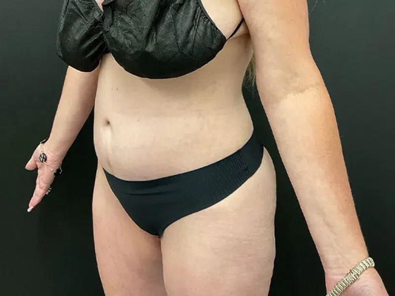 Lower Body Lift Before & After Image