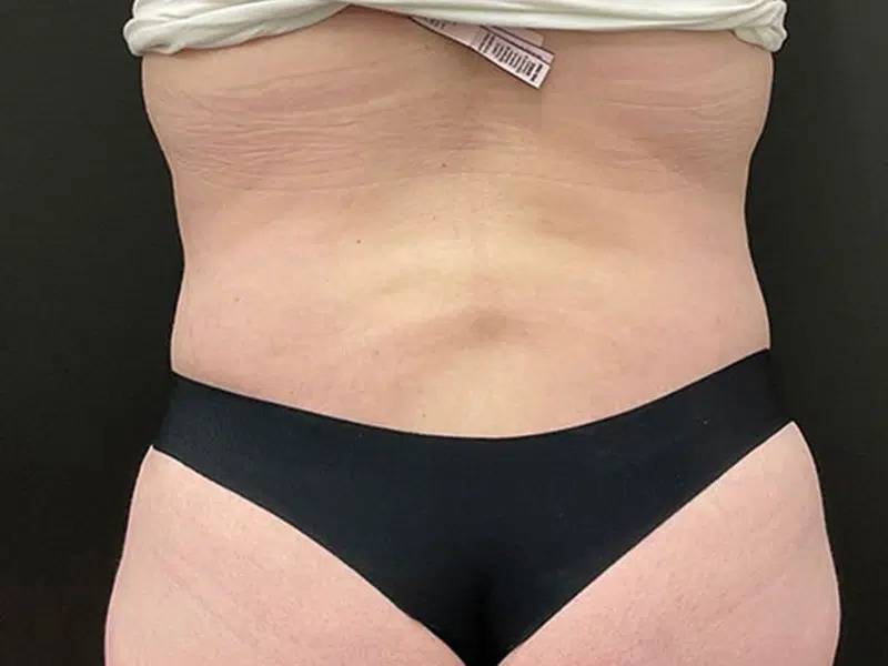 Lower Body Lift Before & After Image