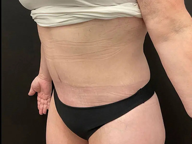 Lower Body Lift Before & After Image