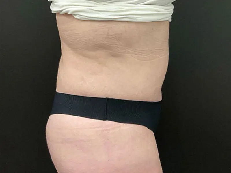 Lower Body Lift Before & After Image