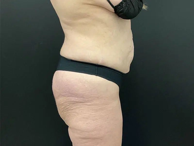 Lower Body Lift Before & After Image