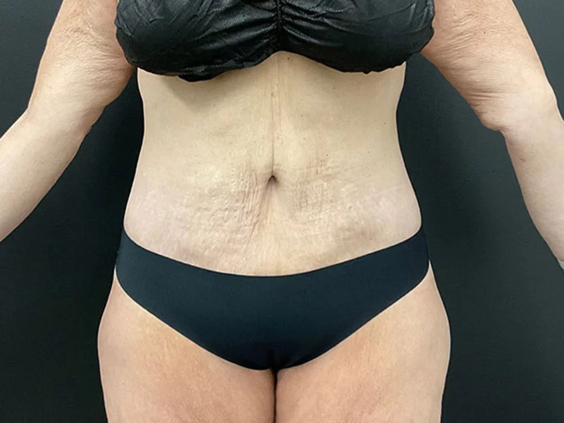 Lower Body Lift Before & After Image