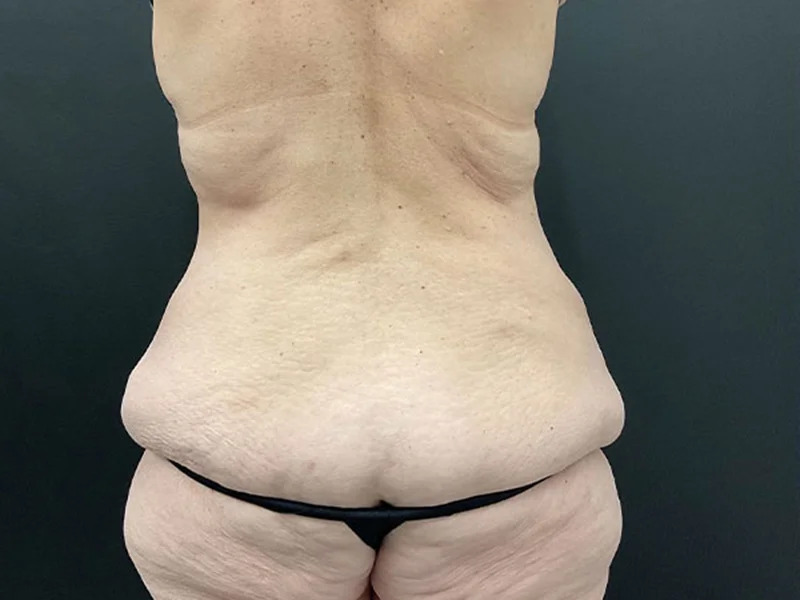 Lower Body Lift Before & After Image