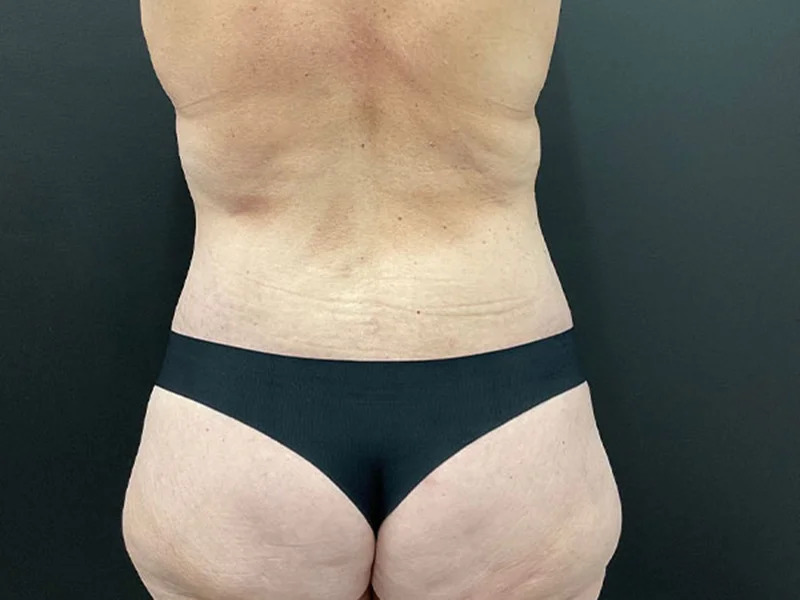 Lower Body Lift Before & After Image