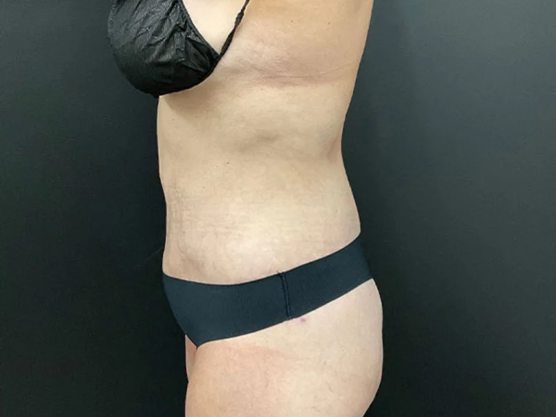 Lower Body Lift Before & After Image