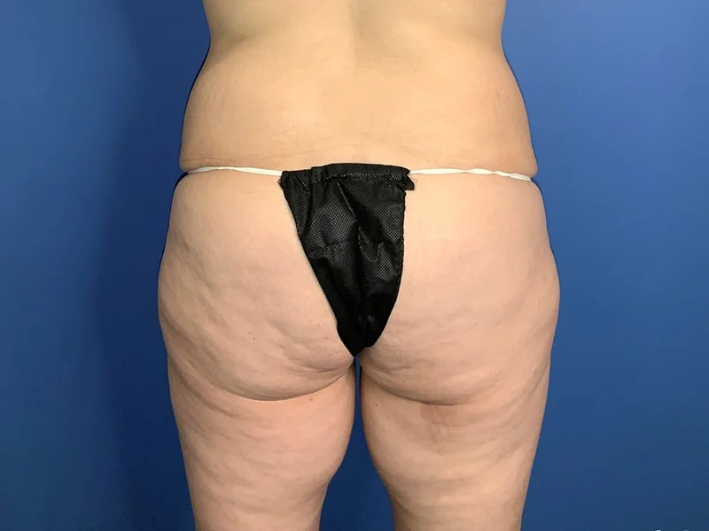 Lower Body Lift Before & After Image