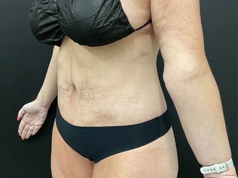 Lower Body Lift Before & After Image