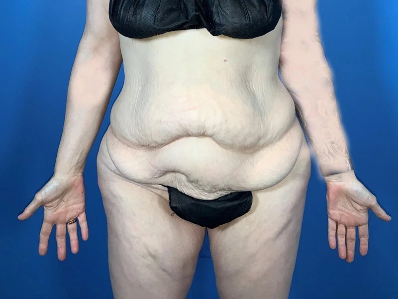 Lower Body Lift Before & After Image
