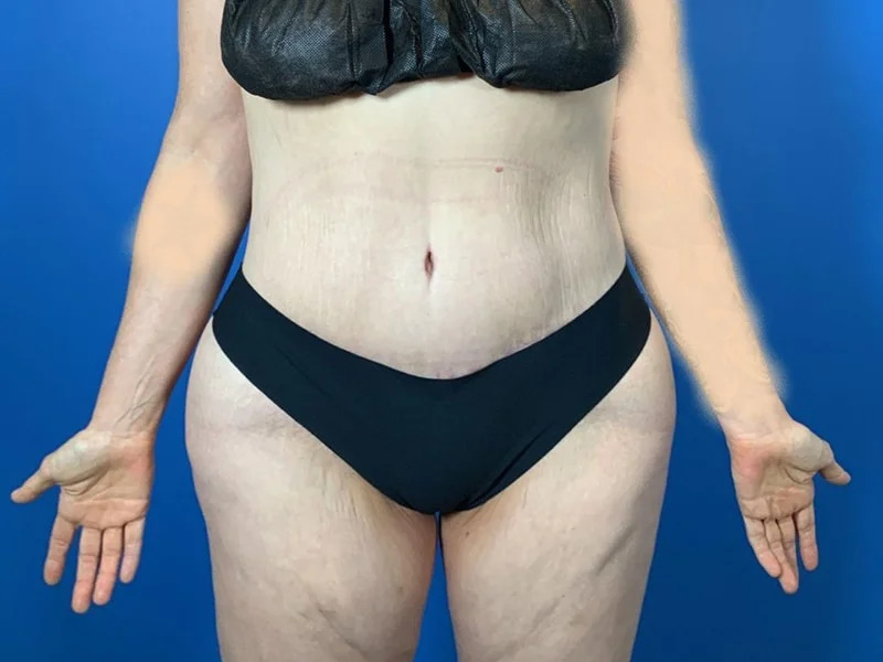 Lower Body Lift Before & After Image