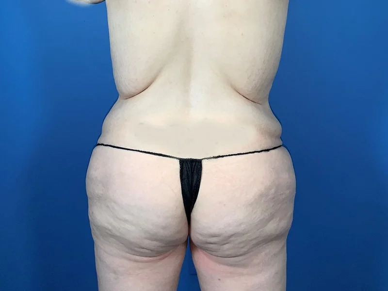 Lower Body Lift Before & After Image