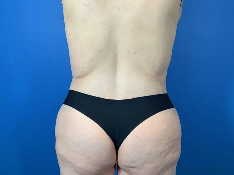 Lower Body Lift Before & After Image