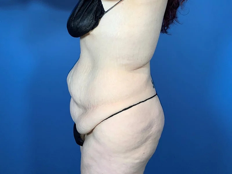 Lower Body Lift Before & After Image