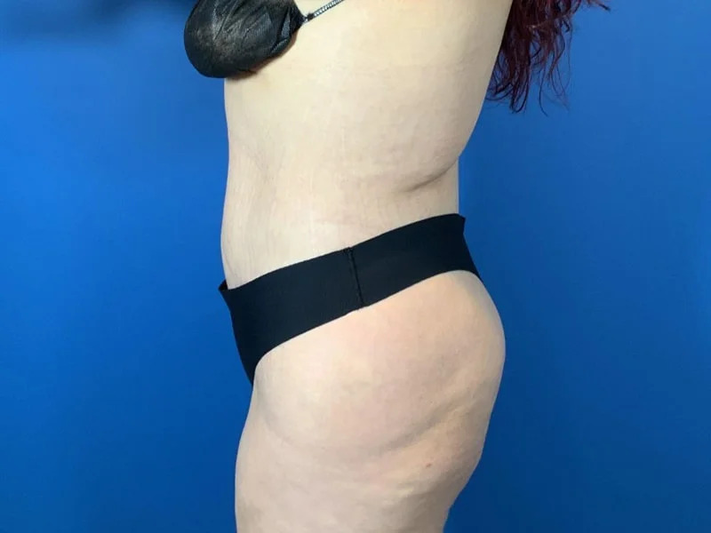 Lower Body Lift Before & After Image