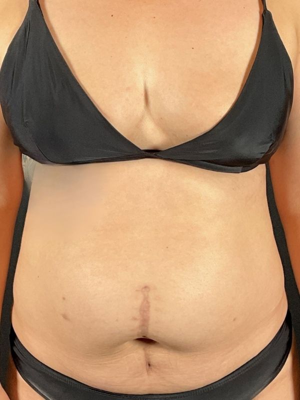 Tummy Tuck Before & After Image