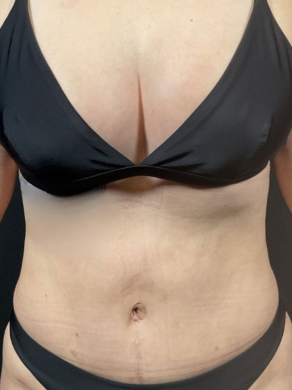 Tummy Tuck Before & After Image