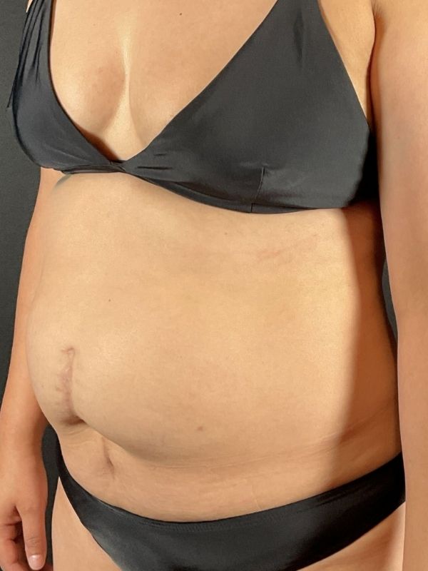 Tummy Tuck Before & After Image