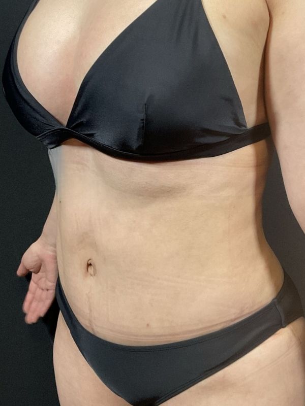 Tummy Tuck Before & After Image