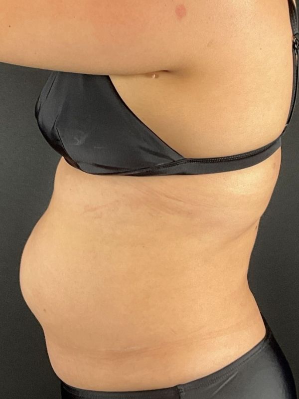 Tummy Tuck Before & After Image