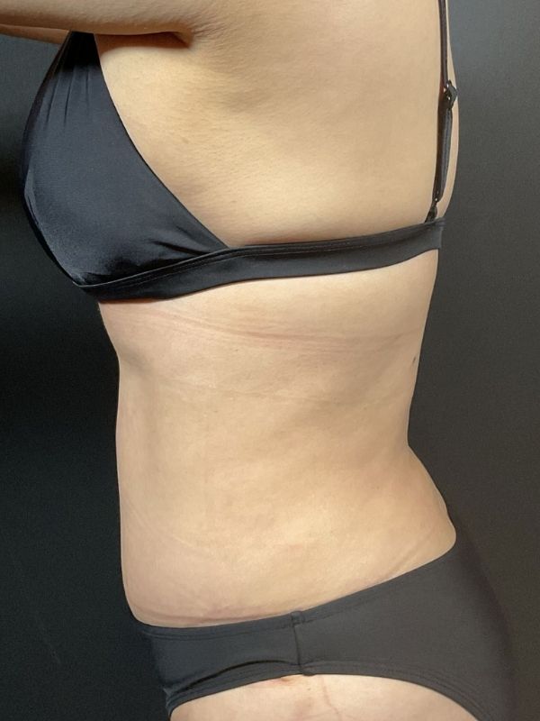 Tummy Tuck Before & After Image