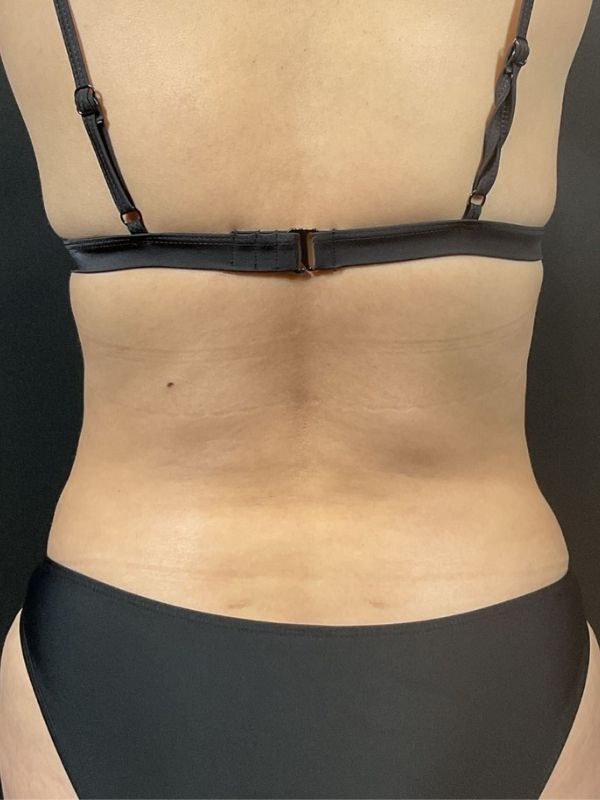 Tummy Tuck Before & After Image