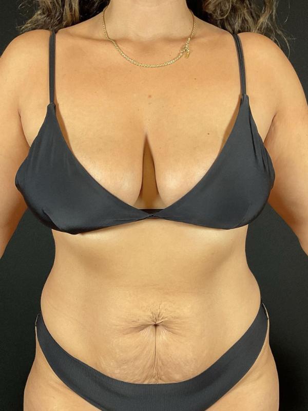 Tummy Tuck Before & After Image