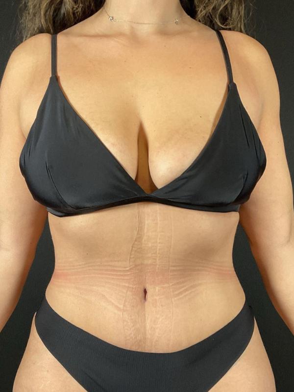 Tummy Tuck Before & After Image