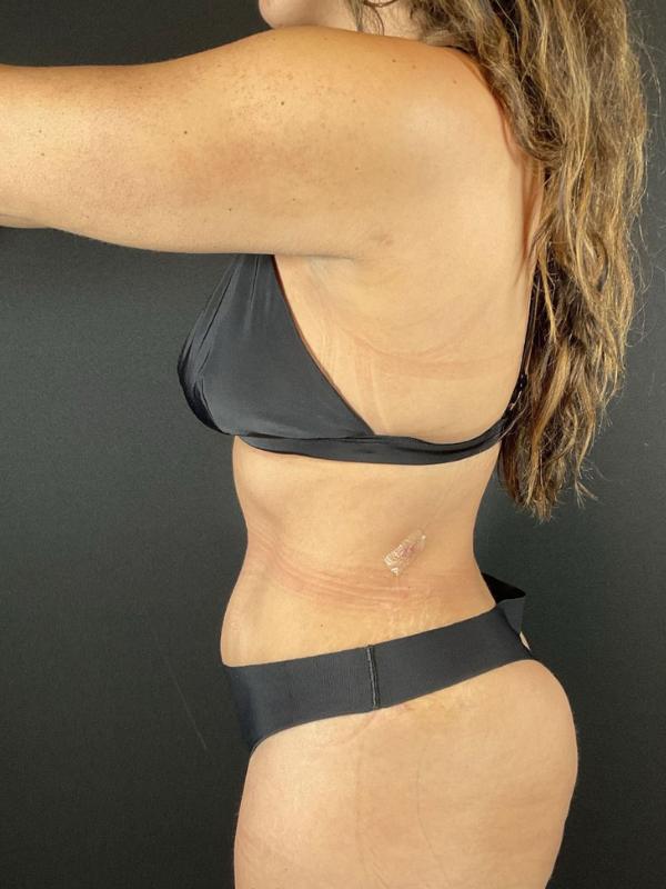 Tummy Tuck Before & After Image