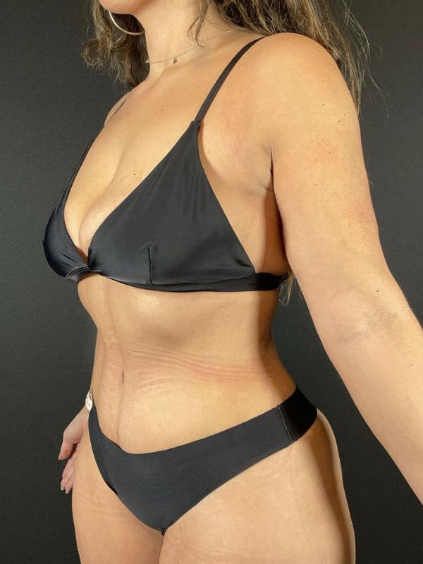 Tummy Tuck Before & After Image