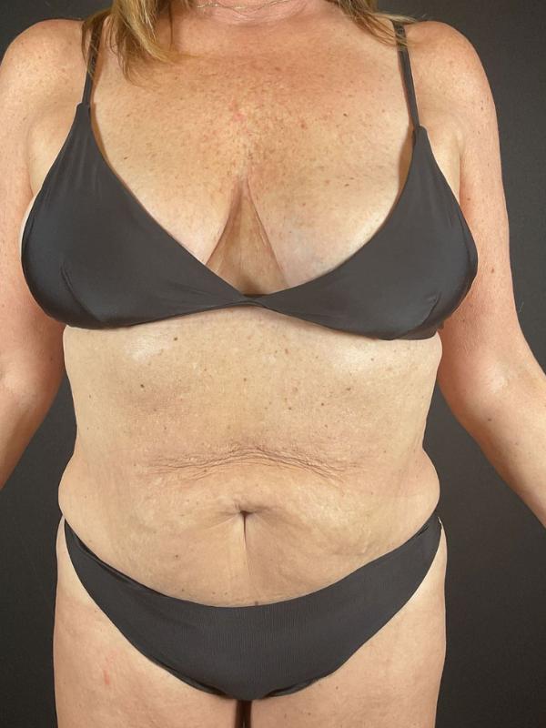 Tummy Tuck Before & After Image