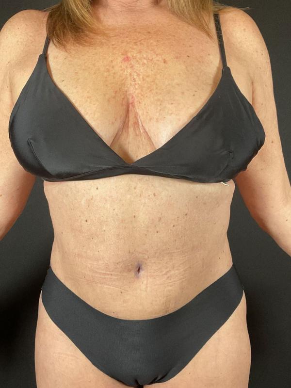 Tummy Tuck Before & After Image