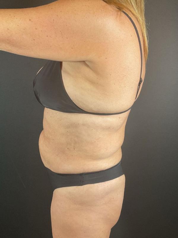 Tummy Tuck Before & After Image