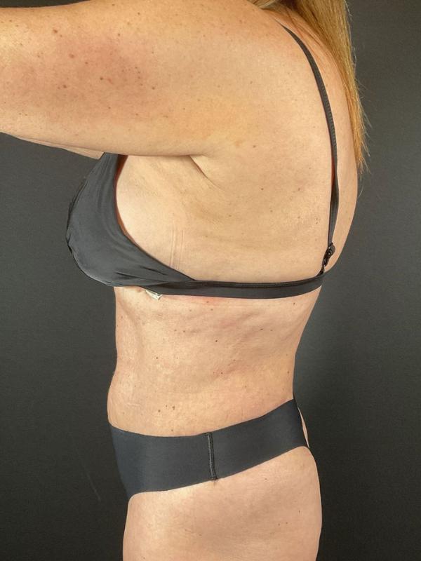 Tummy Tuck Before & After Image