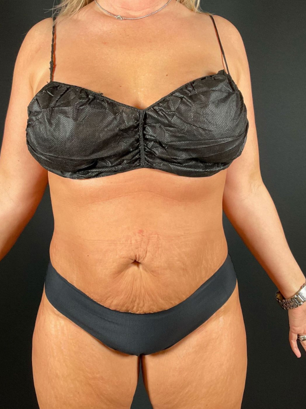 Tummy Tuck Before & After Image