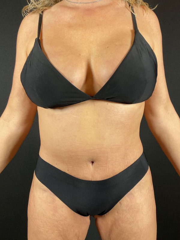 Tummy Tuck Before & After Image