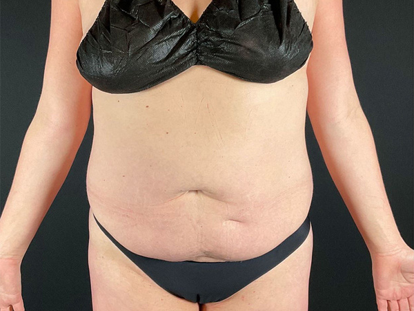 Tummy Tuck Before & After Image