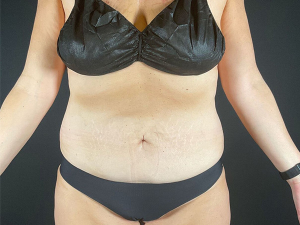 Tummy Tuck Before & After Image