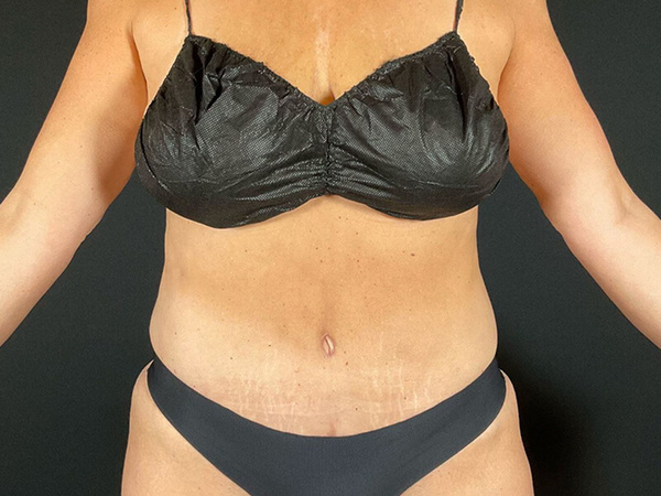 Tummy Tuck Before & After Image