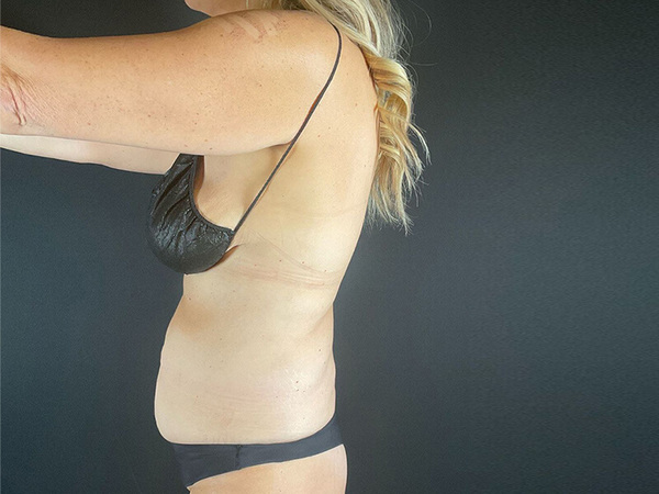 Tummy Tuck Before & After Image