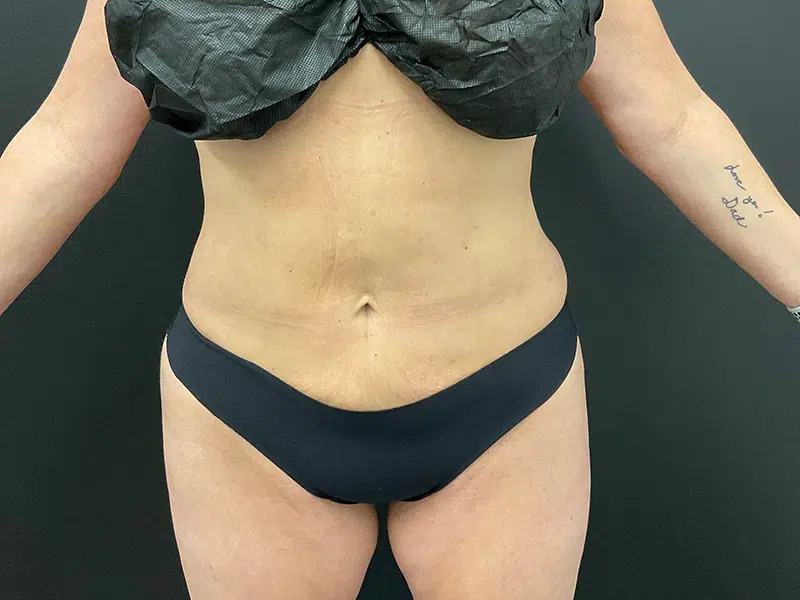 Vaser Liposuction Before & After Image