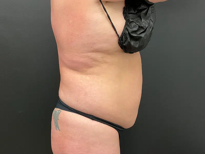 Vaser Liposuction Before & After Image