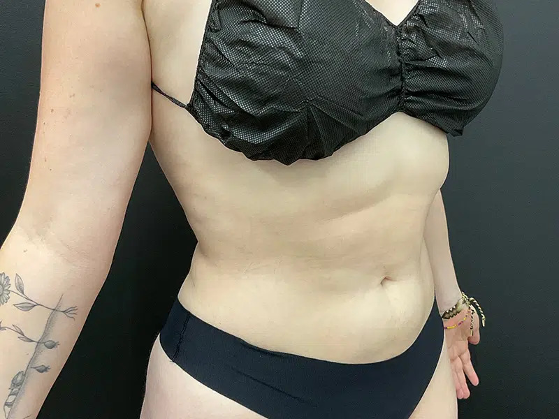 Vaser Liposuction Before & After Image