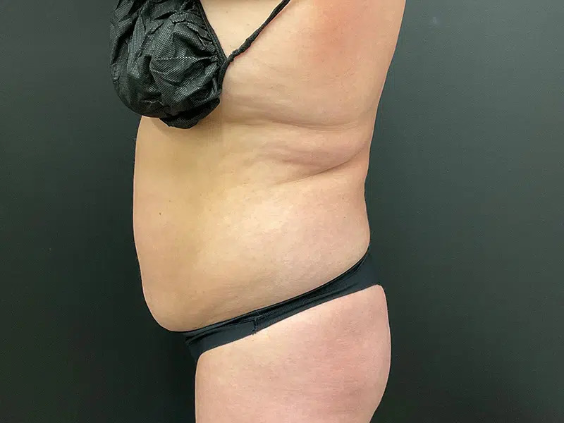 Vaser Liposuction Before & After Image