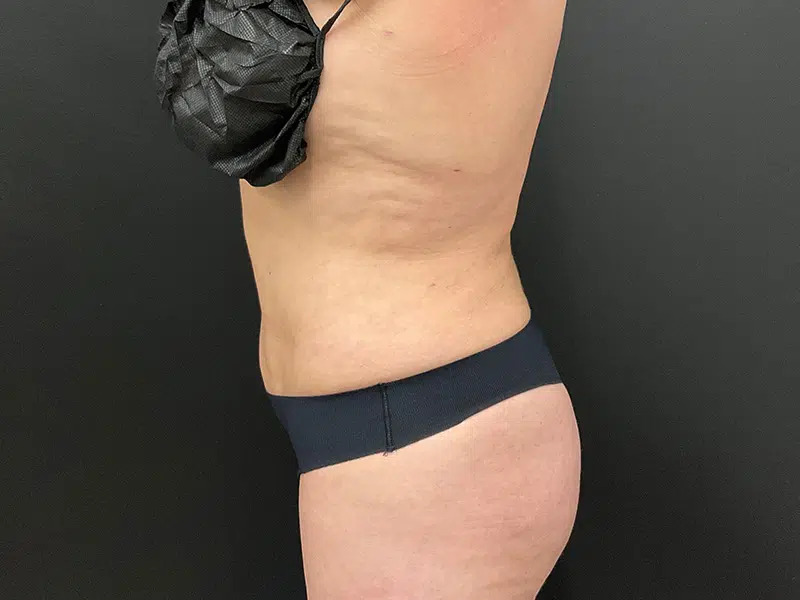 Vaser Liposuction Before & After Image