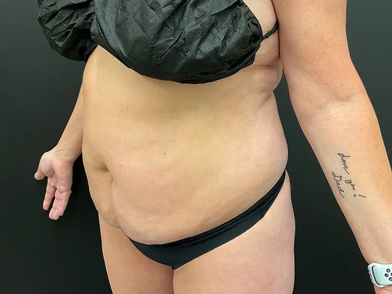 Vaser Liposuction Before & After Image