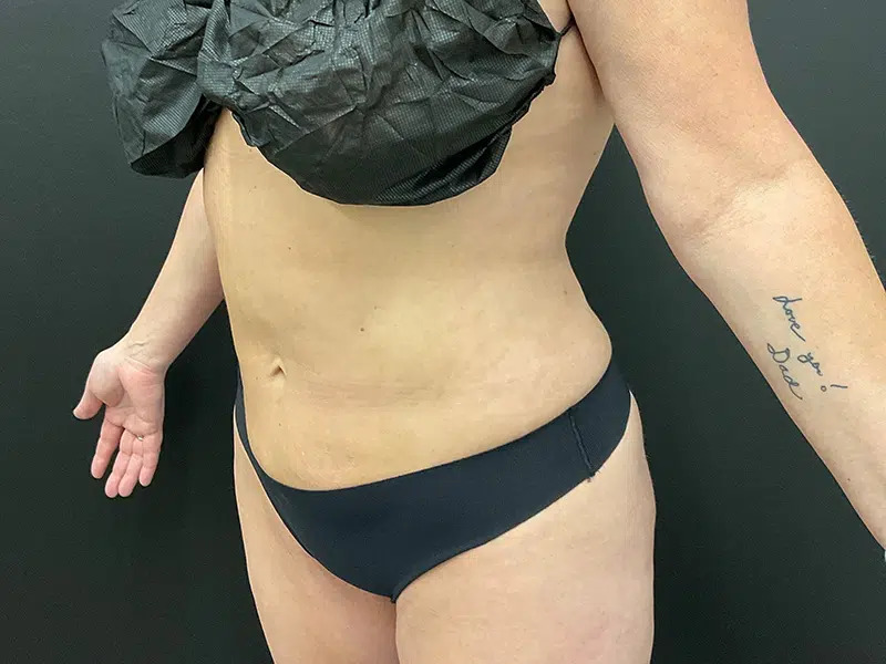 Vaser Liposuction Before & After Image