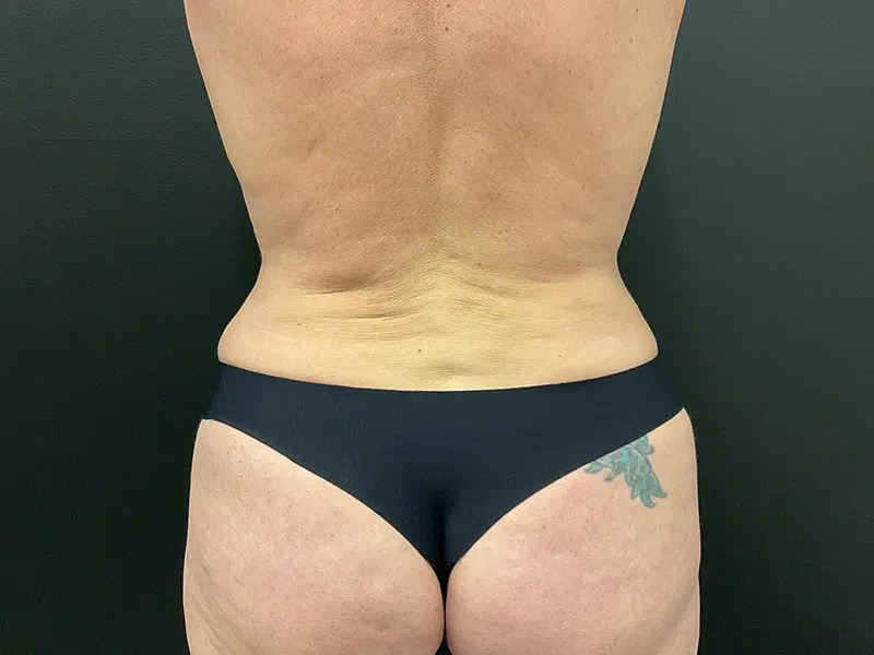 Vaser Liposuction Before & After Image