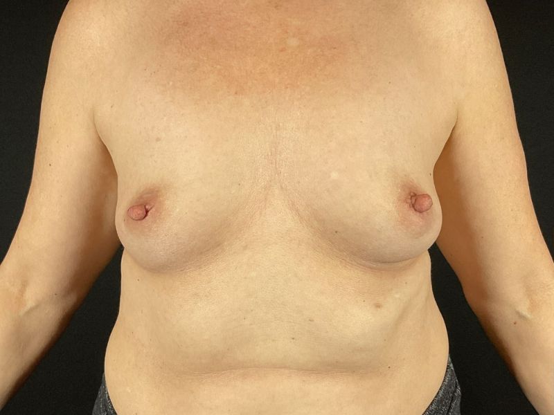 Breast Augmentation Before & After Image