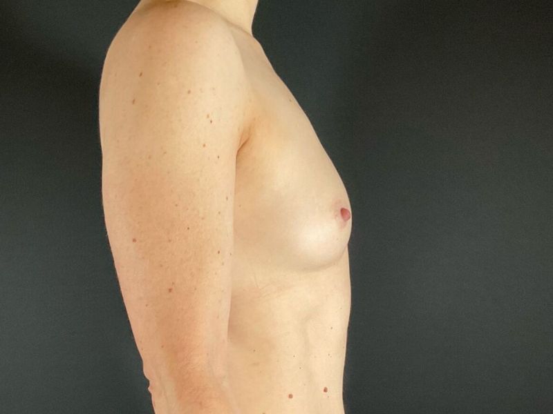 Breast Augmentation Before & After Image