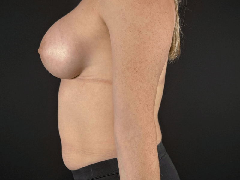 Breast Augmentation Before & After Image