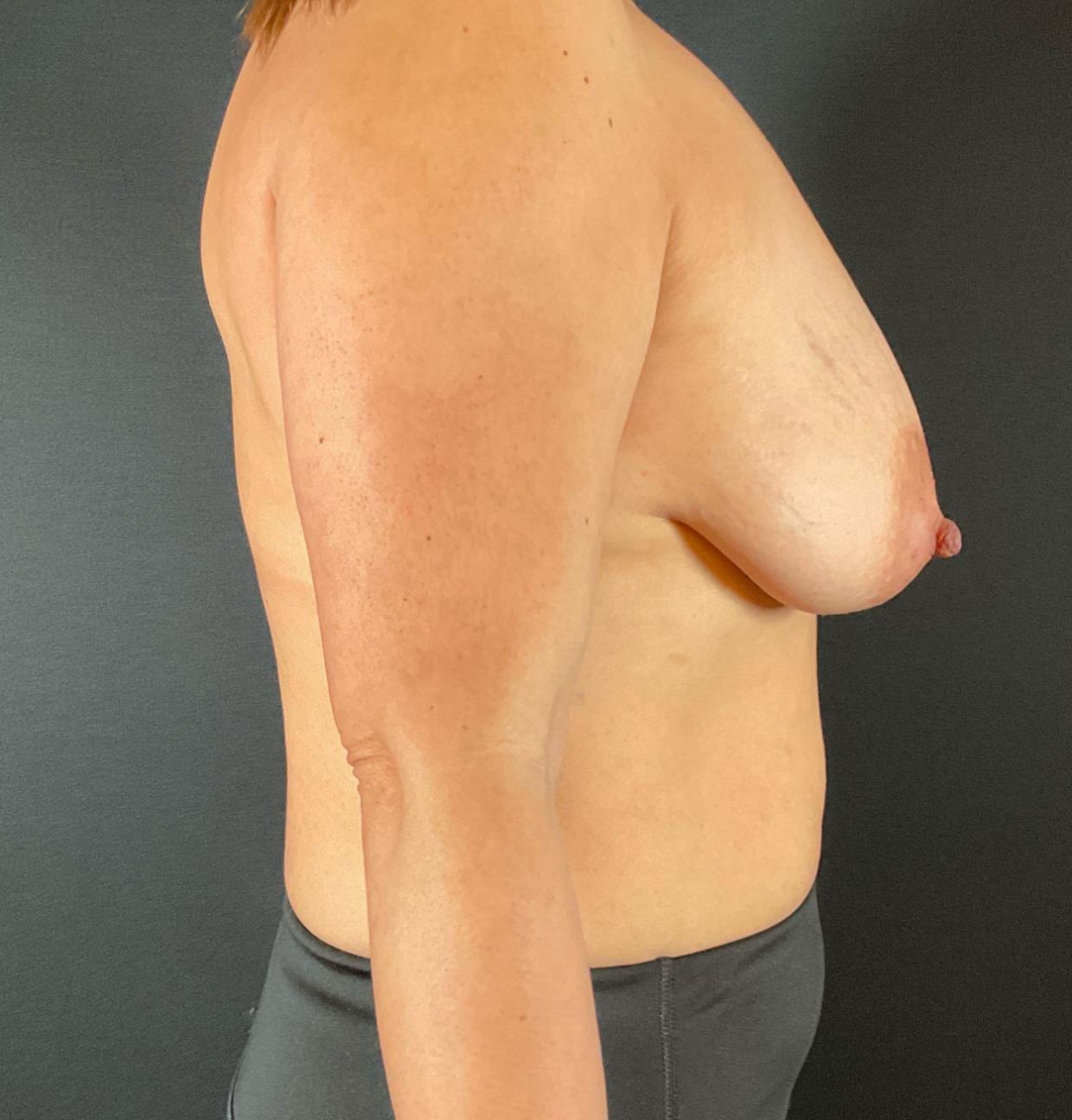 Breast Lift Before & After Image